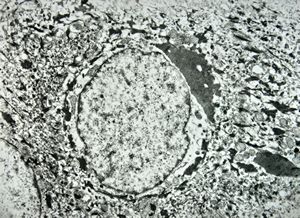 F, 11y. | ichthyosis hystrix type Curth-Macklin